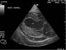 Eine herzbeutelentzündung wird als perikarditis bezeichnet. Perikarderguss Wikipedia