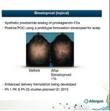 Fatigue and melatonin in parkinson's disease. Elite Hair Institute Has Medical Experts That Have Been On The Cuttting Edge Of Hair Restoration Since 1993