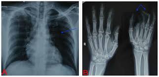 Cureus Brachysyndactyly In Poland Syndrome