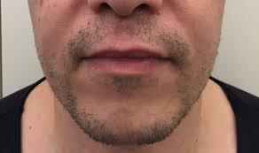 Plusieurs informations sur l'implantation de barbe et la greffe de cheveux avec un prix pas cher pour corriger une barbe incomplète. Greffe De Barbe Et De Moustache Clinique Crillon