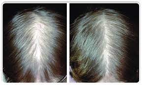 The science behind spironolactone 's success Can Aldactone Be Used For Hair Loss