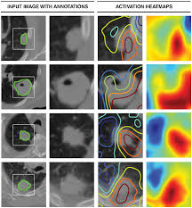 A combination of teal and pink represents thyroid cancer. Plos Medicine Deep Learning For Lung Cancer Prognostication A Retrospective Multi Cohort Radiomics Study
