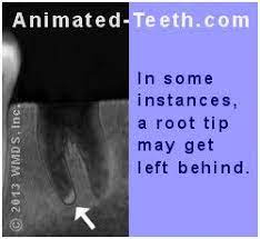 Bone Fragments After Tooth Extraction Sequestra Tooth Shards And Pieces Removal Tooth Extraction Tooth Extraction Care Tooth Extraction Aftercare