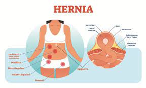 Hernias: Types, Symptoms, And When To Seek Urgent Care - Md Express Urgent  Care