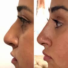Non Surgical Nose Job With Dr Cohen Will Give You All The Benefits Of A Rhinoplasty Without Surgery Nose Job Nose Fillers Rhinoplasty