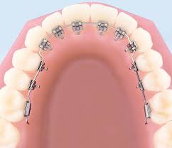 The minimum time to wear braces can be as little as several months to fix a basic crooked tooth or spacing issue through to 36 months for both metal braces and ceramic braces. Lingual Braces How Much Do Lingual Braces Cost Prisma13 Com