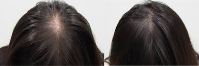 4.40 out of 5 stars. 5 Best Makeup Solutions For Bald Spots Hairguard