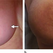 It is called inflammatory because the skin of the breast usually looks red and inflamed. Clinical Features Of Ibc A Photograph Of The Right Breast In A Download Scientific Diagram