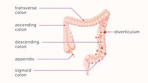 What Is Diverticulitis What Is Diverticulitis Diverticulitis Diverticulitis Symptoms