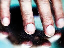 Image result for Acral lentiginous melanoma nail