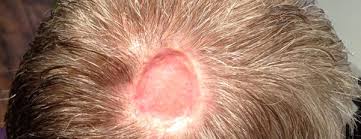 If you are like any other person stressed with the hair loss problems, then try hair weaving in delhi and bonding method as a system of non surgical hair replacement. Baldness Hair Replacement Hair Weaving Microwefting Real Hair Exclusive Hair Transplantation Baldness Treatment Hair Wigs Hair Bonding