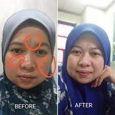 Tiada lagi halangan untuk mendapatkan kulit cantik dan licin. Hanya 100 Peserta Dicari Untuk Sertai Ecurin Ultrawhite Spotless Challenge Dan Terima Produk Bernilai Rm580 Cahaya Hayati