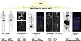 But hearing the words can still be scary. A Prospective Comparison Of 18f Prostate Specific Membrane Antigen 1007 Positron Emission Tomography Computed Tomography Whole Body 1 5 T Magnetic Resonance Imaging With Diffusion Weighted Imaging And Single Photon Emission Computed Tomography