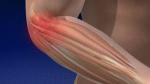 Treatment of epicondylitis by deep. Tennisarm Tennisellenbogen Ursachen Behandlung Symptome Gelenk Klinik De
