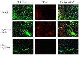 Immune Checkpoints Could Be Key To Treating Autoimmune Disease Myasthenia Gravis Eurekalert Science News