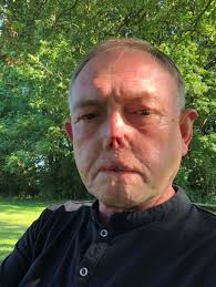 Oldham psychiatrist who had legs amputated below knees after sepsis is  inspiration