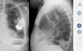 Here a biventricular pacemaker with three leads. Cardiac Device App