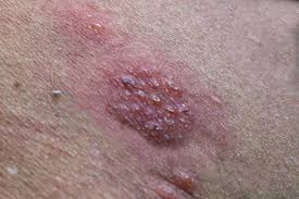 Image result for shingles