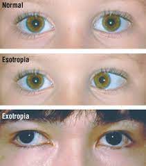 Slowly move the pencil toward the bridge of your nose. Crossed Eyes Strabismus Harvard Health