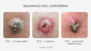 The beginning signs of skin cancer involve a change in the skin. Skin Cancer Pictures Most Common Skin Cancer Types With Images