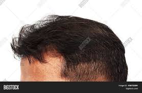 *thyroid imbalance and iron deficiency are reversible causes for hair loss. Hair Loss Male Male Image Photo Free Trial Bigstock