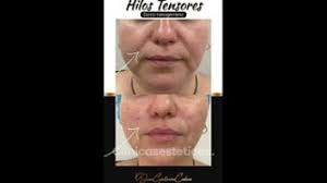 Vídeos de Hilos tensores