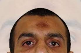 Meskipun tanda hitam tersebut terjadi karena tekanan di dahi ketika sujud, bukan berarti yang tidak bertanda hitam itu jarang sholat ya. Ini Alasan Ulama Ingatkan Hati Hati Tanda Hitam Di Jidat