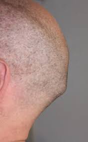 We did not find results for: Plastic Surgery Case Study Occipital Knob Skull Reduction With A Minimal Incisional Technique Explore Plastic Surgery