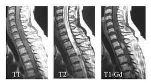 Look up in linguee suggest as a translation of 脊髄 è„Šé«„è…«ç˜ Kompas