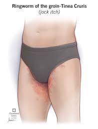 Image result for sore skin in the groin area