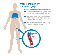 Pin On Dvt And Pe Visualized