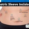 How to get insurance to pay for bariatric surgery. 1