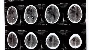 During your scan, your doctor may use a special dye, called contrast, to make areas of the brain easier to see. Space Occupying Lesion With Midline Shift Sol With Mass Effect Brain Tumors Ct Scan Youtube