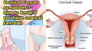 How does it feel to be told you've got cancer, and that it's going to leave you infertile at the age of 24? Womb Cancer Symptoms What It S Like To Have Uterine Or Endometrial Cancer As A Young Woman By New Youtube