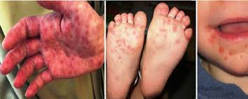 The cause of hand, foot and mouth disease is coxsackievirus a type 16 in most cases, but the infection can also be caused by many other strains of coxsackievirus. Ministry Urges To Prevent Hand Foot And Mouth Disease Vnexplorer