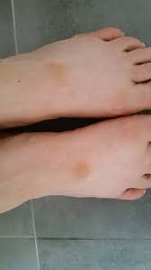 Image result for brown patches on the feet