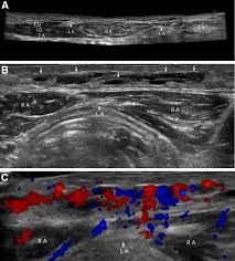 Ment of the second through the sixth ribs. Abdominal Wall Sonography A Pictorial Review Springerlink
