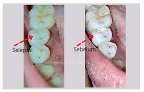 Caj untuk rawatan dan perkhidmatan yang dinyatakan adalah bergantung kadar bayaran yang ditetapkan dalam akta fee. Pengalaman Buat Root Canal Treatment Rawatan Akar Gigi