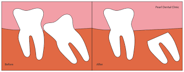 There are normally 4 wisdom teeth, 2 on the top, and 2 on the bottom of your mouth. Coronectomy For Wisdom Teeth At Pearl Dental Clinic In Kingston London
