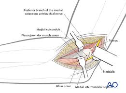 However, operative management is required in cases where there is a displaced fragment, where the fracture is open, or where there is ulnar nerve. Medial Approach