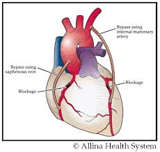 Coronary Artery Bypass Surgery Helping Your Heart Allina Health