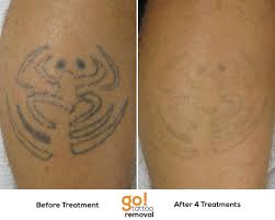 The procedure will be painful, and we can't get around that fact. Laser Tattoo Removal Process Tattoo Design
