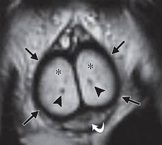 Is gray paint going out of style 2020 priapism in women. Imaging Of Penile And Scrotal Emergencies Radiographics