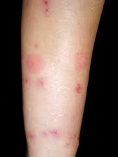 Image result for Cimex lectularius bites