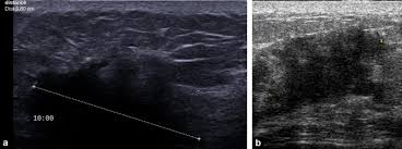 In fact, it can start out with redness of the skin. Imaging Inflammatory Breast Cancer Sciencedirect
