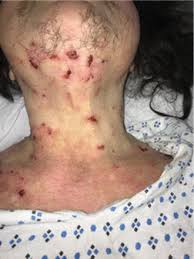 Image result for Neurotic Excoriation