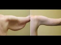 05 Natural Ways To Tighten Skin Including Loose Skin On Arms 05 Natural Ways To Tighten Skin Including Loose Sk Loose Skin Sagging Skin Natural Skin Tightening