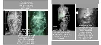 Image result for Necrotizing Enterocolitis