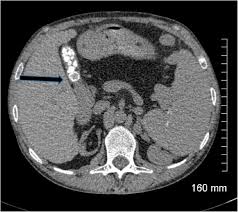 Maybe you would like to learn more about one of these? Gallstones Top To Toe What The Radiologist Needs To Know Insights Into Imaging Full Text