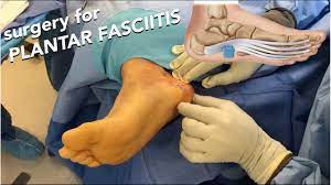 About one in 10 people will develop plantar fasciitis sometime in their lives. Surgery For Plantar Fasciitis Youtube